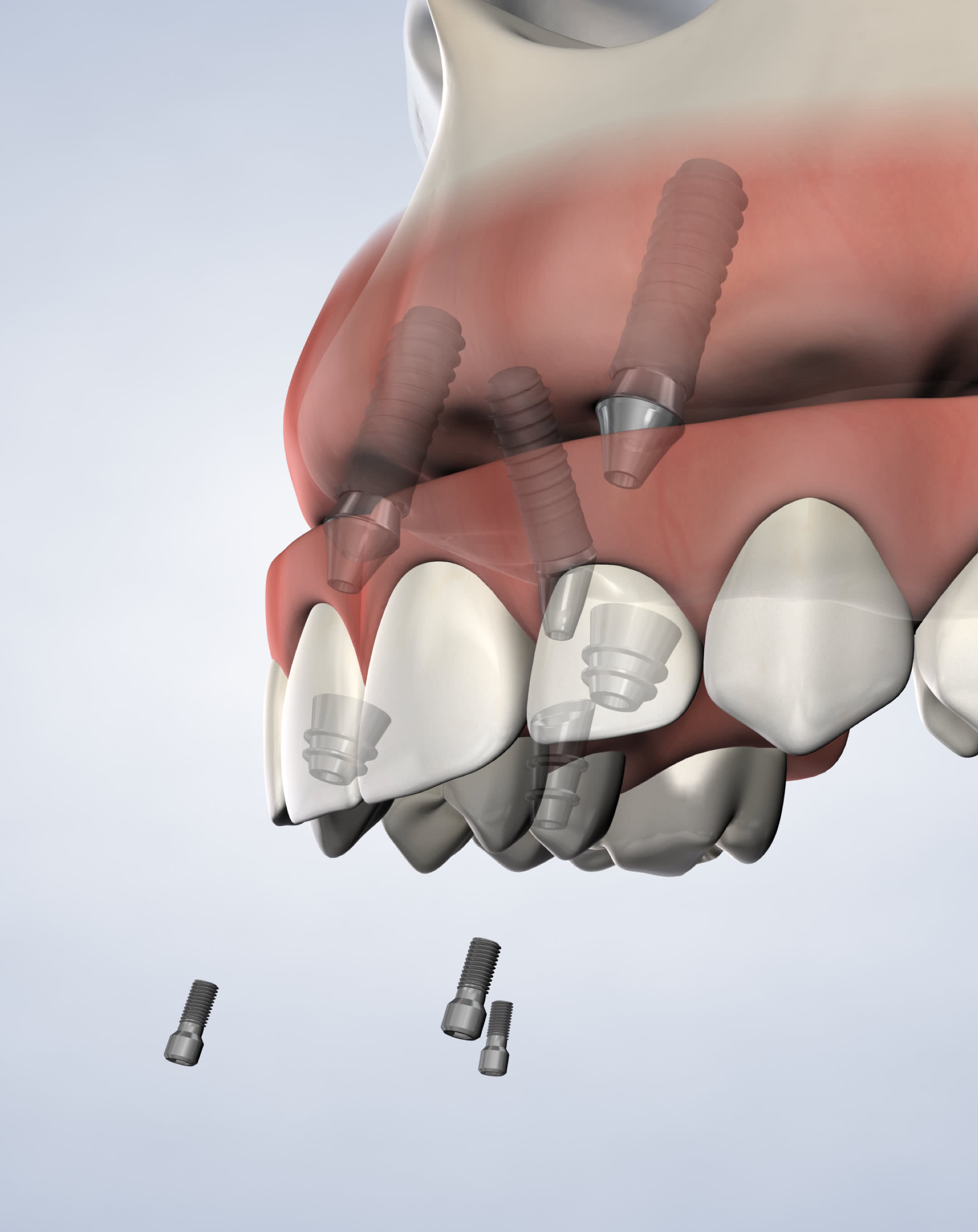 Full arch procedure mobile