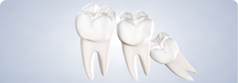 Query wisdom teeth image